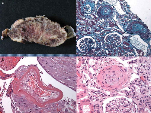 Figure 1. Pathological features of placenta (A and B) and renal biopsy (C and D) in the same patient. A. Macroscopic examination: massive perivillous fibrin deposits throughout the parenchyma. B. Microsopic examination: hyalinized decidual vessels with marked fibrinoid necrosis. C. Fibro-edematous thickening of the arteries, under the endothelial wall and glomerular ischemia (Masson’s trichrome staining). D. Arterial section showing proliferation of myocytes into the layer of the media (concentric ‘onion-skin’ hypertrophy) and edema under the endothelial wall (hematoxylin-eosin-safran staining).