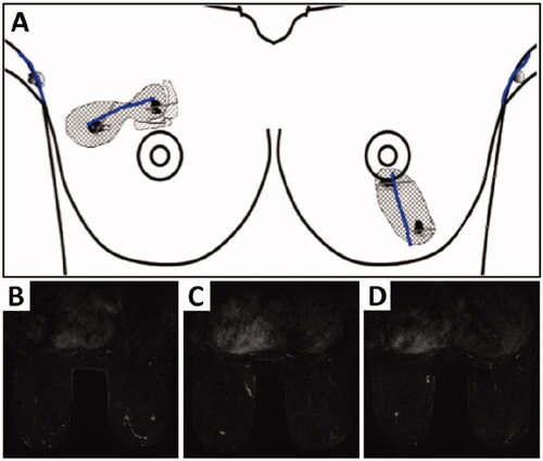 Figure 1. Illustration (A) showing two foci of Grade 1 invasive ductal carcinomas (4 cm apart) in the right breast and two foci of Grade 1 invasive ductal carcinomas (5 cm apart) in the inferior-central and inferior part of the left breast. Bilateral breast MRI with contrast (B) showing an irregular enhancing lesion in the upper outer quadrant measuring 12 × 8 × 13 mm and a second malignancy, measuring 9 × 6 × 11 mm in the upper medial aspect of the right breast at the same level as lesion 1. The left breast (C) shows a 7 mm irregular enhancing lesion at the 6 o’clock position and (D) a second lesion measuring 5 mm located inferolateral to this.
