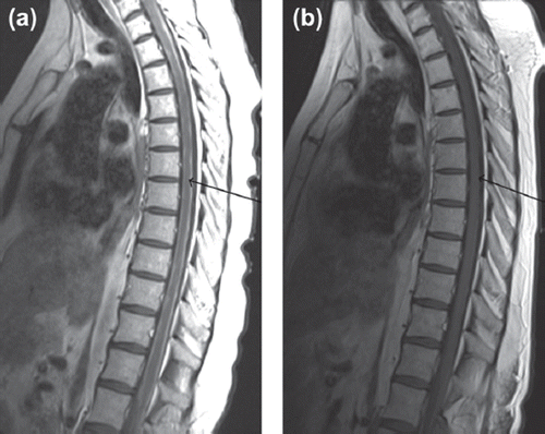 Figure 2. (a) Pre-treatment sagittal T1 weighted post-contrast MR image of the spinal cord – note the diffuse enhancement surrounding the cord as indicated by the arrow. (b) Post-treatment sagittal T1 weighted post-contrast MR image of the spinal cord – improvement is noted as indicated by the arrow.