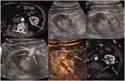 Figure 3. Patient with previous right nephrectomy for RCC who developed a small 9 mm new lesion in the left kidney and was successfully ablated with image guided laser ablation. (A) Contrast-enhanced CT demonstrating a 9 mm posterior enhancing tumor (arrow) in the left kidney. (B) Ultrasound scan demonstrating the left kidney lesion (arrow). (C) Ultrasound scan demonstrating the positioning of the tip of the laser fiber in the middle of the lesion to be treated (arrow). (D) Ultrasound scan demonstrating hyperechoic area due to gas formation during treatment (arrows). (E) Contrast-enhanced ultrasound demonstrating the absence of enhancement at the level of the treated lesion (arrows). (F) Contrast-enhanced MRI at 3 months demonstrating the complete treatment of the renal lesion (arrows = ablative area).