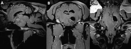 Figure 6. Post-mortem T1w high-resolution 3D reconstructable magnetization-prepared gradient-echo (3D MP-RAGE), (A) transverse, (B) sagittal and (C) dorsal plane magnetic resonance images of the head of a 16-year-old warmblood mare, depicting partial removal of the adenoma, but also inadvertent removal of portions of the thalamus.