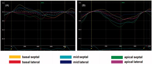Figure 4. Dispersion of segmental longitudinal strain curves in the apical 4-chamber view in patients with right bundle branch block. (A) In a patient with non-ischemic cardiomyopathy, despite visually synchronous left ventricular contraction, there is a significant dispersion of segmental longitudinal strain curves’ peaks. (B) In a patient with ischemic cardiomyopathy, left ventricular contraction appears synchronous on both visual inspection and strain imaging. Lower values of peak systolic longitudinal strain of the lateral wall segments are concordant with lateral wall akinesis. AVC indicates aortic valve closure.