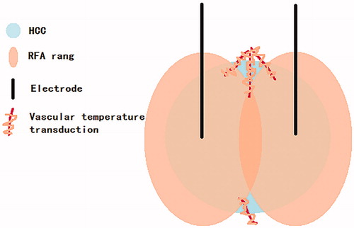 Figure 5. The hypothesis of overlapping ablation temperature conduction along the vessel to the residual tumor.