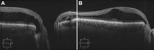 Figure 1 Optical coherence tomography imaging of the patient’s right eye on initial presentation, demonstrating (A) an inferotemporal optic nerve pit with retinoschisis, intraretinal fluid, subretinal fluid, and (B) significant macular schisis.