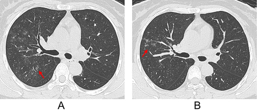 Figure 3 A 47-year-old female patient infected with the Omicron variant. (A and B) Axial computed tomography (CT) images exhibit a tree-in-bud pattern (red arrow) and patchy ground-glass opacities (GGOs) in the right upper lobe.