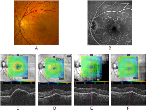 Figure 4 Case example of a 72-year old female with an occult subretinal neovascular membrane in the left eye due to age-related macular degeneration. The baseline fundus image (A) and fluorescein angiograph (B) are shown. (C–F) represent four different optical coherence tomography (OCT) images. (C) represents the OCT at the moment of diagnosis, showing a large pigment epithelium decollement (PED). (D) shows the status after treatment with Aflibercept showing a persistent PED and a neurosensory decollement (NSD) after an attempt of interval prolongation beyond 4 weeks. Brolucizumab was then started, panel (E) shows the OCT-image after the first loading dose (4 weeks). (F) shows the same patients after a 9-week interval with Brolucizumab injections, note a further decrease in PED and a persistent decrease in NSD.