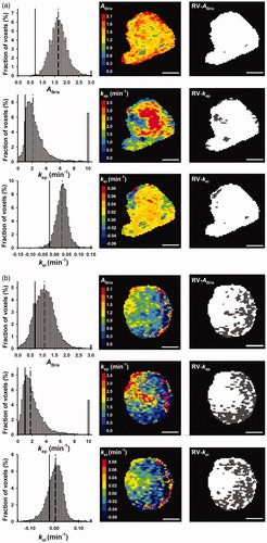 Figure 1. ABrix, kep, and kel frequency distributions, parametric images, and binary images highlighting RV-ABrix, RV-kep, and RV-kel in dark gray for a representative high-enhancing (a) and a representative low-enhancing (b) tumor. The frequency distributions include all tumor voxels, whereas the images refer to a single slice through the tumor. To avoid presenting the entire tail of the frequency distributions, the last column of the distributions represents the percentage of voxels with ABrix ≥ 3.0, kep ≥ 10, and kel ≥ 0.15. The vertical lines in the frequency distributions represent the threshold ABrix, kep, and kel values of RV-ABrix, RV-kep, and RV-kel (solid lines) and the median values of ABrix, kep, and kel (dashed lines). Scale bars: 1 cm.