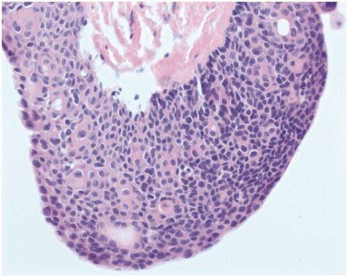 Figure 4. High power image of a solid area shows basaloid cells typical of poroma and occasional ductal structures (top right corner). The cells are uniform and cytologically bland. No mitotic figures are seen.