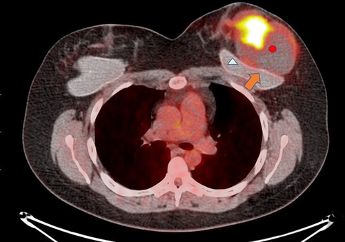 Figure 3 PET-CT of the tumor (red circle) shows 18FDG uptake, especially in the mass area inside the tumor. The uptake in the tumor capsule is less intense, but well defined in the acquired images. The silicone implant (white triangle) is rotated, with a low uptake area in the fibrous capsule dehiscence (orange arrow).