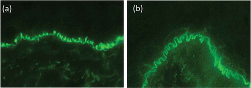 Figure 6. Direct immunofluorescence microscopy. (a) u-serrated deposition of IgG along the basement membrane zone in a patient with EBA. In contrast, in all of the pemphigoid diseases, an n-serrated pattern is seen, as exemplified in a patient with bullous pemphigoid (b). Magnification x 1000.