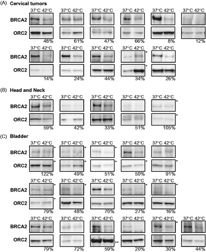 Figure 3. BRCA2 degradation in tumours heated ex vivo. Immunoblots of (A) 11 cervical tumours, (B) five head and neck tumours, and (C) 16 bladder tumours. Each pair of samples represents the non-hyperthermia-treated and treated samples of a tumour sample. ORC2 is shown as a loading control. Percentages at the bottom of each panel indicate the relative intensity of the BRCA2 signal (corrected to ORC2) in the heat-treated sample compared to the non-treated sample. *For clarity of presentation, the shadow values were reset from 0 to 175 in Adobe Photoshop. **PARP-1 is shown as a loading control and as an alternative to ORC2, because the latter could not be detected in this sample.
