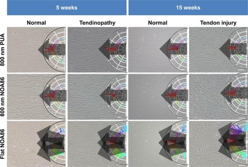 Figure 2 TDSCs were seeded and cultured on the PUA substrate with 19.8 MPa stiffness and 800 nm-wide nanogrooves, NOA86 substrate with 2.4 GPa stiffness and 800 nm-wide nanogrooves, and NOA86 substrate with 2.4 GPa stiffness and flat surface.Note: Irrespective of age and pathological status, TDSCs cultured on the 800 nm NOA86 and 800 nm PUA substrates were well aligned along the grooves while cells cultured on the flat NOA86 were not.Abbreviations: NOA86, Norland Optical Adhesive 86; PUA, polyurethane; TDSCs, tendon-derived stem cells.