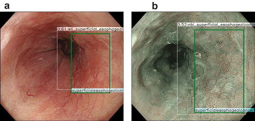 Figure 2. Representative images of esophageal cancer detected by artificial intelligence.