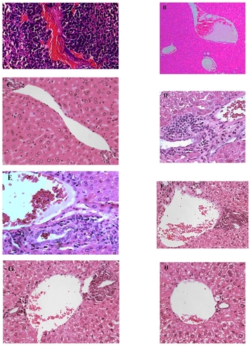 Figure 6 Histostaining of liver of mice: Effect of CXCR4 siRNAs on inhibition of colorectal cancer metastasis to liver in vivo. A) H and E staining of tumor show growth and angiogenesis in Group A. B) H and E staining of liver (original magnification 10×) in Group F without injection of tumor cells; in this group there were no infiltrative lymphocytes. C) H and E staining (original magnification 40×) of liver in Group F. D) H and E staining of liver (original magnification 40×) in Group A along with subcutaneous injection of tumor cells through tail vein, showing a lot infiltrative lymphocytes between the hepatic parenchyma and portal vein following metastasis of tumor cells to the liver. E) H and E staining (original magnification 40×) of liver in Group B. F) H and E staining (original magnification 40×) of liver in Group C. G) H and E staining (original magnification 40×) of liver in Group D. H) Hematoxylin and eosin staining (original magnification 40×) of liver in Group C. Metastases in Groups A, B, C, D, and E were compared with Group E.Abbreviation: H and E, hematoxylin and eosin.