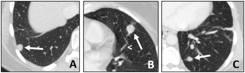 Figure 1. (A, B and C) Lung metastases presentation on CT-scan. Patient with three metachronous, bilateral metastases (arrows) from a rectal cancer. All metastases are sub-pleural, in the lung bases, with well-defined margins. In image B, there is a vessel going into the tumor, this is called ‘the Feeding-Vessel’ sign (arrowhead).