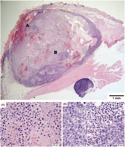 Figure 4. The low magnification (2×) photomicrograph of a MTGB flank mammary adenocarcinoma (top) treated with mNPH (CEM60 to the centre of the tumour, 24 h after treatment) and cisplatin demonstrated uniform tumour necrosis. Higher magnification (100×) demonstrates a more detailed view of the necrosis (A) and the partially viable tumour present in isolated regions (B). The regions with viable tumour are located primarily at the deep tumour margin. This tumour was assessed 24 h following treatment, therefore additional treatment effect is likely ongoing. A normal hyperplastic lymph node is visible in the lower right quadrant of the low magnification image. H&E stain.