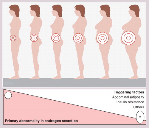 Figure 2. Polycystic ovary syndrome as the result of the interaction of a primary abnormality in androgen synthesis, manifesting as androgen excess, with environmental factors such as abdominal adiposity, obesity and insulin resistance.In one extreme (†), in some patients, the disorder is severe enough to result in polycystic ovary syndrome even in the absence of triggering environmental factors. In the other extreme (‡), a very mild defect in androgen secretion is amplified by the coexistence of abdominal adiposity, obesity and/or insulin resistance. Between the two extremes, there is a spectrum in the severity of the primary defect in androgen secretion, explaining the heterogeneity of polycystic ovary syndrome patients with regards to the presence of obesity and metabolic comorbidities. However, patients share a primary defect in androgen secretion.Reproduced from Citation[6], with permission. © Elsevier (2007).