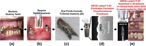 Figure 19. (a) picture of natural teeth destroyed by bacteria; (b) picture of Ti-alloy DIs inserted in a patient’s maxillary bone; (c) picture of a Ti-alloy extracted from a patient maxillary bone after about 4 years implantation, showing chemical corrosion produced by the oral fluids; (d) cross-section SEM image of a UNCD-coated Ti-alloy DI, showing excellent dense/pinhole-free extremely conformal UNCD coating; e) pictures of UNCD-coated DI in a patients’ maxillary bone, showing an X-ray image (top left), during implantation (top right), after 3 months implantation (middle) and with crown inserted on top (bottom).