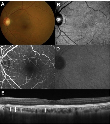 Figure 3 Findings in the left eye 60 months after the first visit: (A and B) the dark reddish lesion (A) was faintly observed without a dark area on scanning laser ophthalmoscopy infrared imaging (B); (C and D) on late-phase fluorescein angiography (C) and indocyanine green angiography (D), hypofluorescent lesions corresponding to the acute macular neuroretinopathy lesion almost resolved; (E) optical coherence tomography revealed complete recovery of the inner/outer segment junction with partial discontinuity of the cone outer segment tip line (arrows).