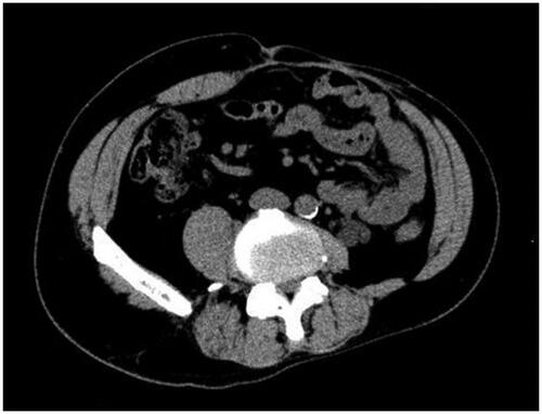 Figure 4. Axial CT image of the abdomen 13 months after last surgery. There is no sign of recurrence of the hernia.