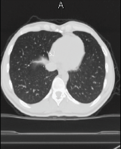 Fig. 2.  Thoracic CT scan with metallic particles in pulmonary vessels.