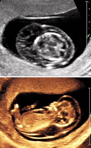 Figure 6 Upper panel: First-trimester septated cystic hygroma at 10 and 4/7 weeks’ gestation. Lower panel: Note marked sacculation extending caudally, and overall subcutaneous edema, consistent with nonimmune fetal hydrops (NIHF). Non-invasive prenatal screening was not obtained and the patient elected to undergo continued expectant management (despite being counseled regarding the likelihood of subsequent fetal demise). Following anticipated fetal demise she underwent uterine evacuation without testing of products of conception.