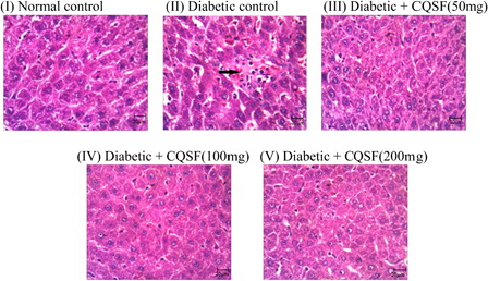 Figure 4. Histology of liver in experimental rats after 45 days of treatment. (I) Normal control – normal liver showing normal hepatic cells. (II) Diabetic control – showed extensive hepatocellular damage in the form of mild inflammation, sinusoidal dilation, fatty changes, and extensive vacuolization with disappearance of nuclei. (III), (IV), and (V) Diabetic + CQSF – shows only mild inflammation and there is restoration of normal tissue morphology.