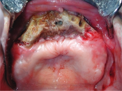 Figure 6 Early clinical picture of the lower jaw in patient treated with Aredia® and Zometa® for 24 months (48 years old, female, breast cancer).