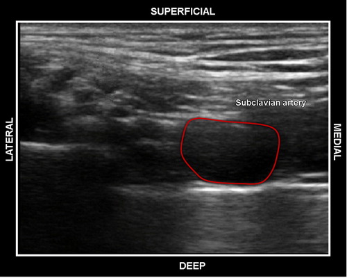 Figure 5: SCA presents as a hypoechoic structure on the ultrasound screen.