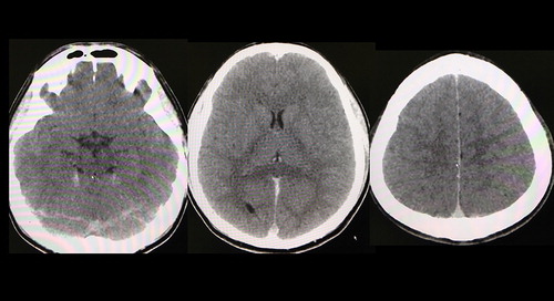 Figure 1. Postmortem pulmonary cranial computed tomography (CT) findings. CT reveals the loss of cerebral sulcus, suggesting diffuse brain edema.