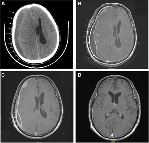 Figure 1 Neuroimaging studies of a 58-year-old male patient with Salmonella subdural empyema. (A) Axial computed tomography showing massive right convexity subdural fluid collection (white arrows) with midline shift at emergency department. (B) Axial T1-weighted magnetic resonance imaging showing thick residual subdural fluid collection (white arrows) with rim enhancement 4 days postoperatively. (C) Axial T1-weighted magnetic resonance imaging showing significantly reduced subdural empyema (white arrows) with improved midline shift before discharge. (D) Axial T1-weighted magnetic resonance imaging showing vanishing subdural empyema without midline shift after more than 5 years follow-up.