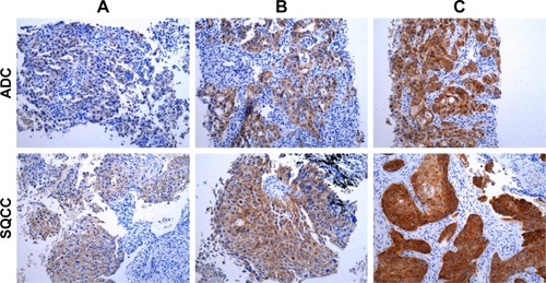 Figure 1 Representative immunohistochemical staining sections for NANOG with different histologic scores (H-scores) (×200).