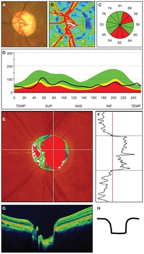 Figure 1 Representative photographs of a patient with the generalized enlargement disc type of glaucoma. (A) Fundus photograph of the left optic disc. (B) Color map from LSFG-NAVI (Softcare, Ltd, Fukuoka, Japan). (C) Average thickness of the retinal nerve fiber layer thickness in the clock area. (D) Circumferential retinal nerve fiber layer thickness pattern in a patient with glaucoma. (E, F) Results of Heidelberg retina tomograph II. (G) Vertical section through the center optic nerve by three-dimensional optical coherence tomography.