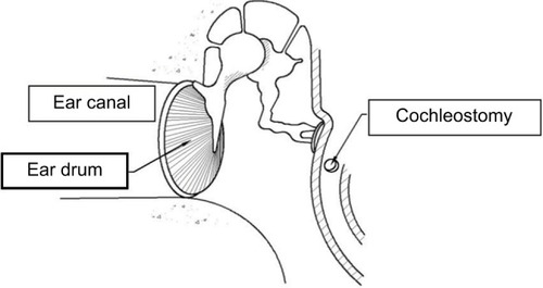 Figure 1 Diagram illustrating the anatomy of the ear and location of a cochleostomy.