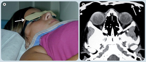 Figure 1. Bismuth eye shield for computed tomography.(A) Shows a child just before CT scanning with eyeglasses covered with a bismuth shield (white arrow) that protects from irradiation. (B) Axial CT soft tissue window at the level of the orbits demonstrate the bismuth shield with no underlying artifact in the image obtained.Reprinted with permission from Elida Vazquez, MD, Hospital Materno-Infantil Vall d’Hebron, Barcelona, Spain.