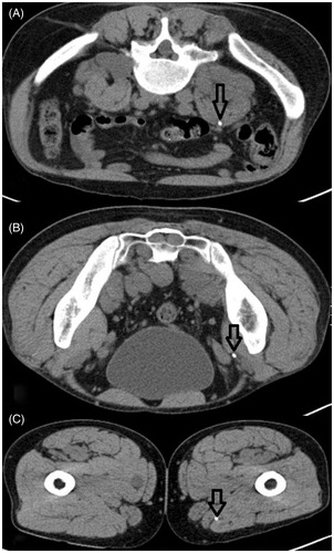 Figure 3. Severe catheter dislocation in the same patient mentioned in Figure 2. (A–C) Catheter dislocated from its original retroperitoneal intratumoural position down to the upper leg along the fascial space. Arrows indicate the position of the catheter.