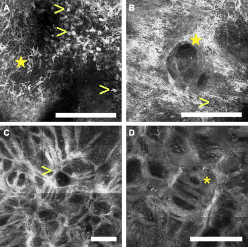 Figure 4 Reflectance confocal microscopy images of a lentigo maligna. The epidermis (depth ~50 µm) shows numerous pleomorphic pagetoid cells composed of large round cells (arrowheads, A) as well as dendritic cells (star, A), which can invade the hair follicles (star, B). At the dermal-epidermal junction (depth ~150 µm), one can also identify disarrangement of the basal layer as well as large plump cells which correlate with melanophages (arrowhead, B), and junctional thickenings than can radiate from the hair follicles adopting a medusa head-like () structure (arrowhead, C), or a mitochondria-like structure (asterisk, D). (white scale bars: 250 µm).