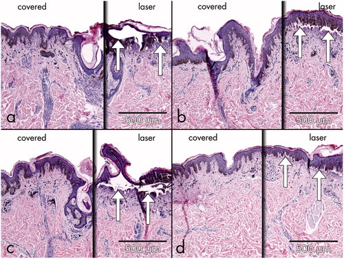 Figure 3. Histological changes after a single pass with an alexandrite laser (30 J/cm2, 40 ms) on a skin explant of a congenital nevus half covered with (a) zinc paste, (b) PU foam, (c) sunscreen, and (d) wooden spatula.
