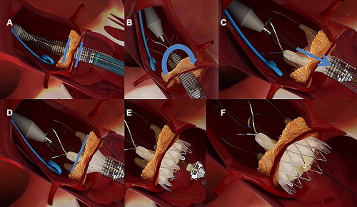 Figure 2. Delivery sequence: (A) Intra-annular positioning of the device (blue bars indicating the annular level), (B) anatomical correct rotation (blue arrow) of the device, (C) partial unsheathing and pulling of the device (blue arrow) and placement of the upper crown, (D) after correct placement of the upper crown the lower crown (E) is released with the valve self-aligned within the aortic annulus (F).