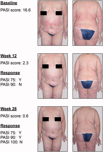 Figure 4. Photographic comparison of PASI responses and residual disease. In this 64-year-old White female weighing 104.9 kg, PASI 75 and PASI 90 response estimates were poor predictors of residual disease during treatment. PASI score assessment during follow-up visits more reliably accurately reflected clinical observation than did percentage improvement from baseline PASI score. PASI: Psoriasis Area and Severity Index.