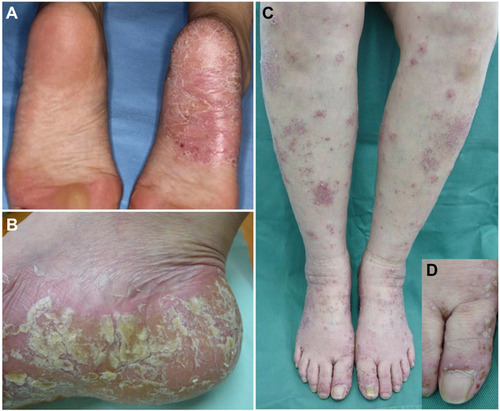 Figure 1 Atypical features of PPP. (A) Unilateral plantar involvement. (B) Plantar hyperkeratosis and erythematous lesions. (C) A number of ill-defined erythematous lesions with scales on the lower extremities. (D) Small pustular lesions.