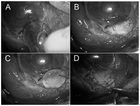 Figure 2 Using a corneal trephine (5.5 mm diameter), half-layered corneoscleral tissues was dissected away (A). Clean, healthy edges of the dissection were regularized (B). Then a donor’s lamellar, round, preserved corneal piece with 5.5 mm diameter and 0.8 mm thickness was placed (C) and was sutured exactly to the patient’s corneoscleral area with 10-0 nylon (D).