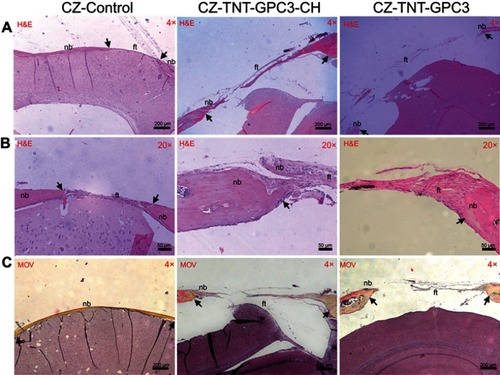 Figure 7 Histological images showing bone regeneration in the critical-sized defects (CSDs) of three groups of Crouzon murine model (with Fgfr2c342y/+ knock-in mutation) at day 90 post-operatively for (A) H&E staining at a low magnification (×4), (B) H&E staining at a high magnification (×20), and (C) Movat Pentachrome (MOV) staining at a low magnification (×4). Images A and B were prepared from different slices of the same CSD (for each group) that displayed the features most clearly at each magnification. Black arrows mark the new bone in the CSDs.Notes: CZ-Control, Crouzon murine model without Titania nanoimplants or proteins (i.e. surgical control); CZ-TNT-GPC3-CH, Crouzon murine model with Titania nanotubes loaded with glypican 3 protein and also coated with chitosan; CZ-TNT-GPC3, Crouzon murine model with Titania nanotubes loaded with glypican 3 protein (but no chitosan coating).Abbreviations: nb, new bone; ft, fibrous tissue; CH, chitosan; GPC3, glypican 3 protein; TNT, Titania nanotube.