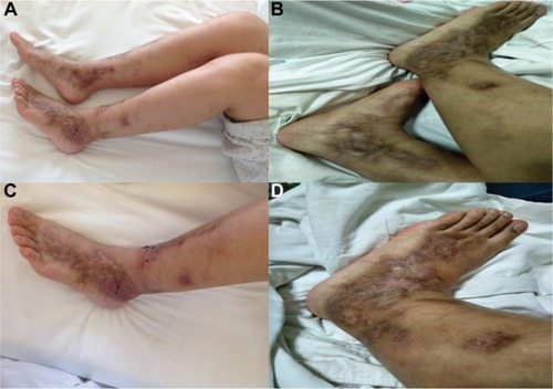 Figure 3 Case 2: before the treatment of rivaroxaban (A and C) and after the treatment of rivaroxaban (B and D).