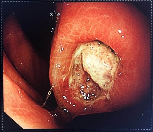 Figure 1 Endoscopic manifestation of GIST with ulceration and active bleeding.Abbreviation: GIST, gastrointestinal stromal tumor.
