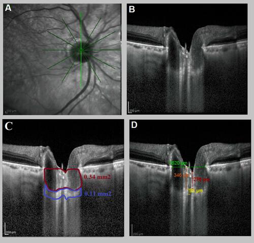Figure 1 Right eye of a mild POAG patient (MD = −4.35). (A) The axial scans of the optic nerve head. (B) The enhanced depth imaging with spectral-domain optical coherence tomography (EDI-OCT) device (Spectralis, Heidelberg Engineering, Heidelberg, Germany) of lamina cribrosa (LC). (C) EDI-OCT assessment of LC showed that: Blue square showing the lamina cribrosa area (0.11 mm2) and the red square prelaminar neural tissue area (0.34 mm2). (D) EDI-OCT assessment of LC showed that: yellow line showing LC thickness 93 µm, red line showing prelaminar neural tissue thickness (276 µm), and orange line showing anterior lamina cribrosa surface depth (346 µm). Green line showing reference line connecting both ends of Bruch’s membrane opening.