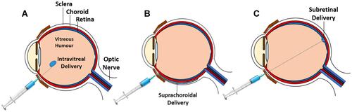 Figure 1 Images showing different methods of intraocular gene delivery: (A) intravitreal, (B) suprachoroidal, and (C) subretinal.