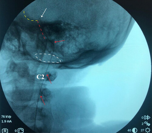 Figure 1. Location of intrathecal catheter tip confirmed by the fluoroscopy during surgery. The red arrow indicates the intrathecal catheter; the white arrow indicates the tip of catheter; white dash cycle indicates the foramen magnum; red dash cycle indicates the clivus; the yellow dash cycle indicates the pituitary fossa.