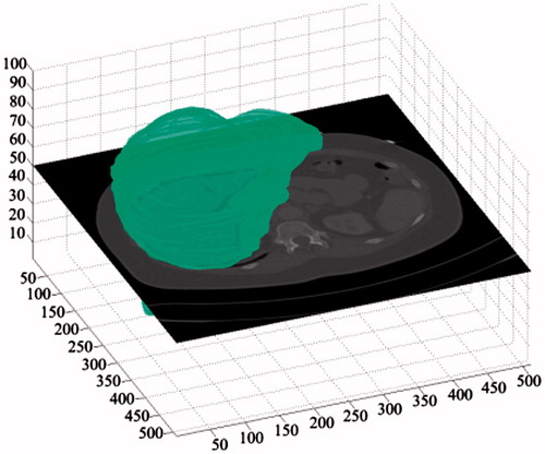 Figure 3. The Most likely liver region (MLLR).