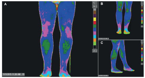 Figure 2 Thermogram of lower extremities (normal study).